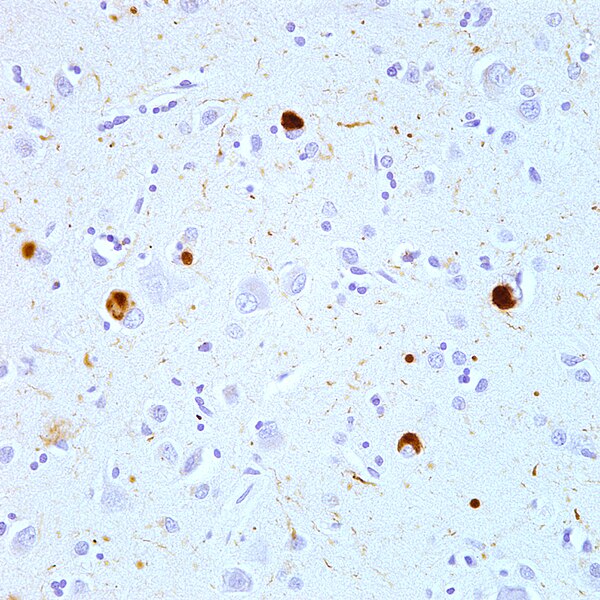 File:Immunostaining (brown) of alpha-synuclein in Lewy Bodies and Lewy Neurites in the neocortex of a patient with Lewy Body Disease.jpg