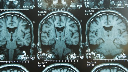 brain electro stimulation