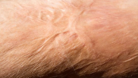 burn scars on someone's skin