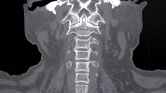 cervical CT scan