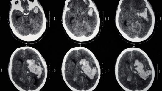 CT intracerebral hematoma