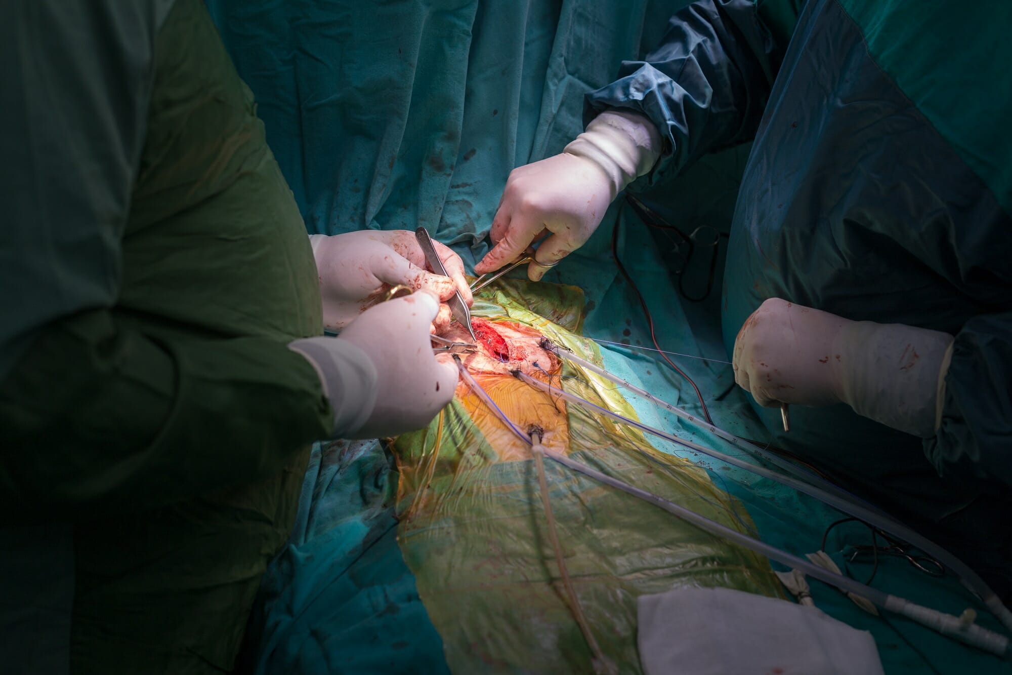 Heart surgery in hospital