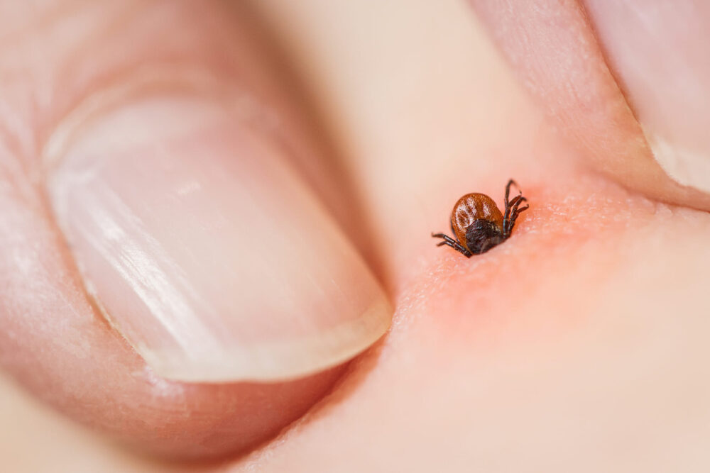 Tick-bite -inflammation and-irritation-of-the-skin.-Risk-of-infection-with-encephalitis-or-Lyme-disease.