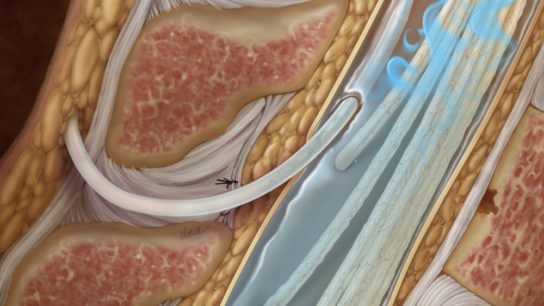 Intrathecal drug delivery