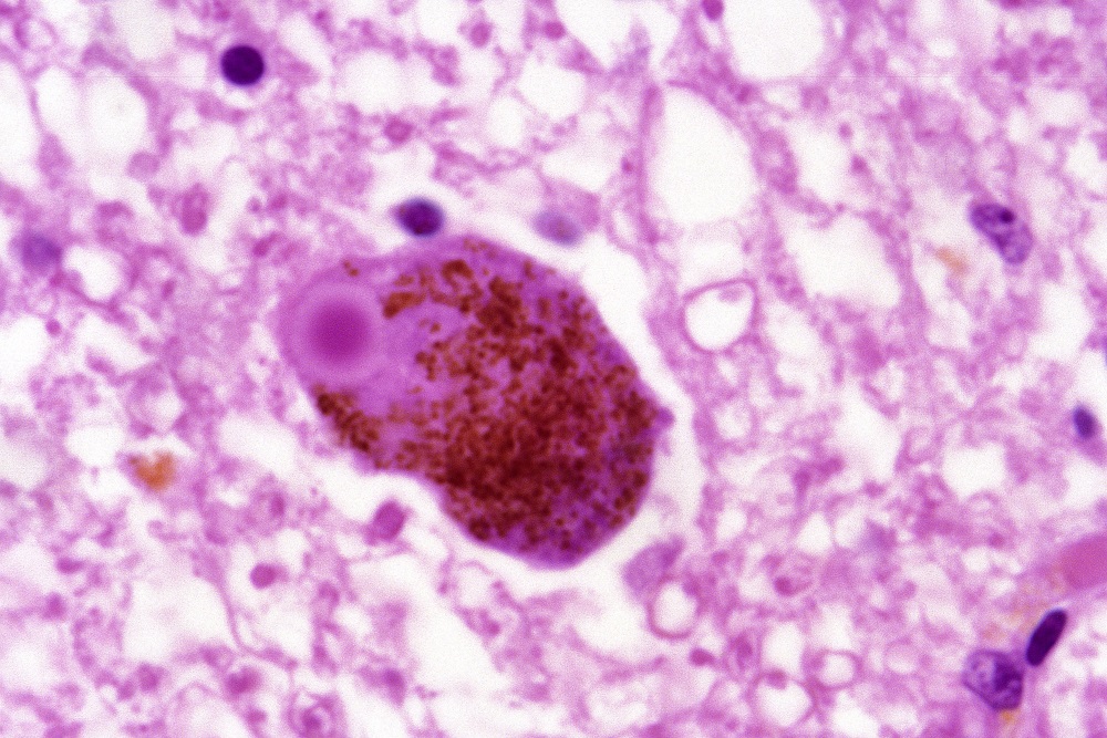 lewy body parkinson's