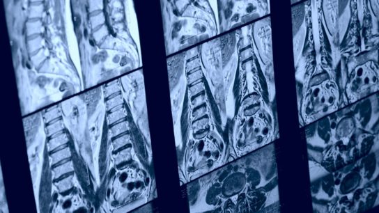 MRI of a spine