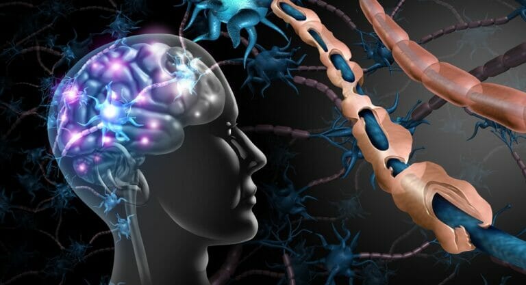 multiple-sclerosis-3D-illustration