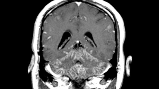 Neurosarcoidosis