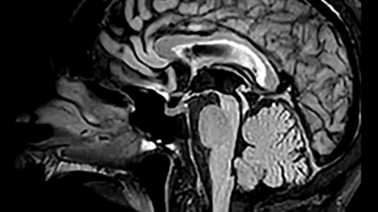 progressive supranuclear palsy
