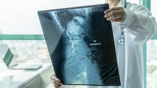 Spinal-Muscular-Atrophy