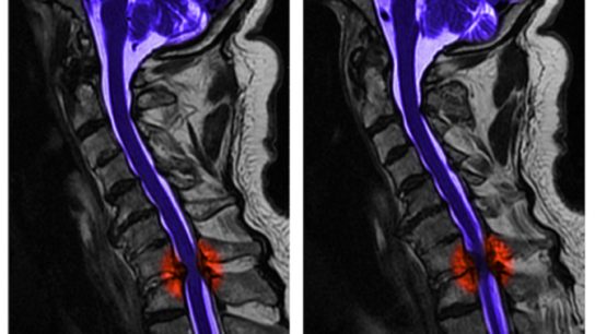 Imaging of spinal cord injury