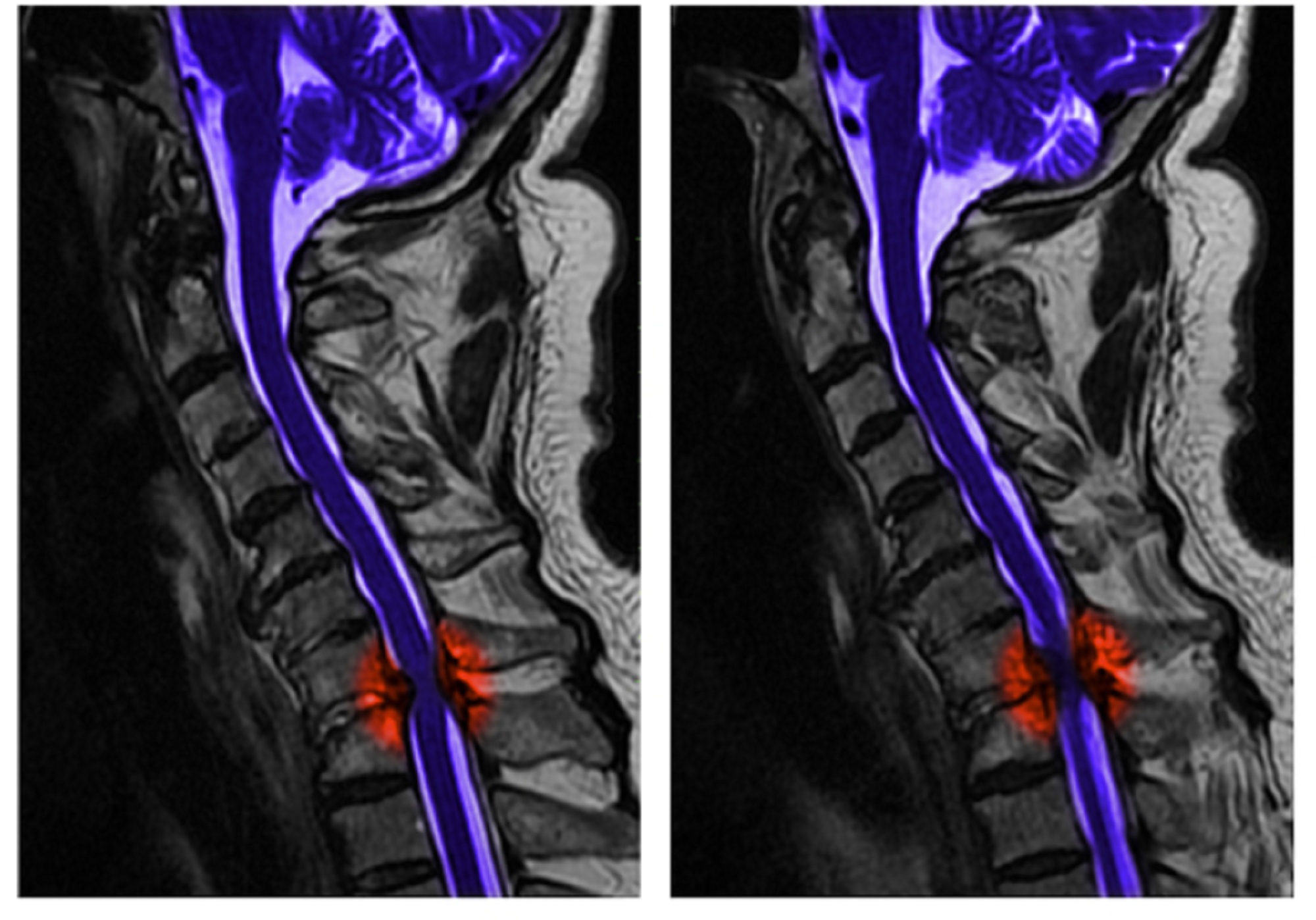 Imaging of spinal cord injury