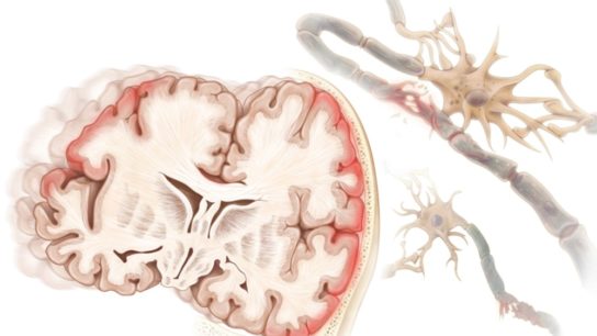 TBI brain concussion