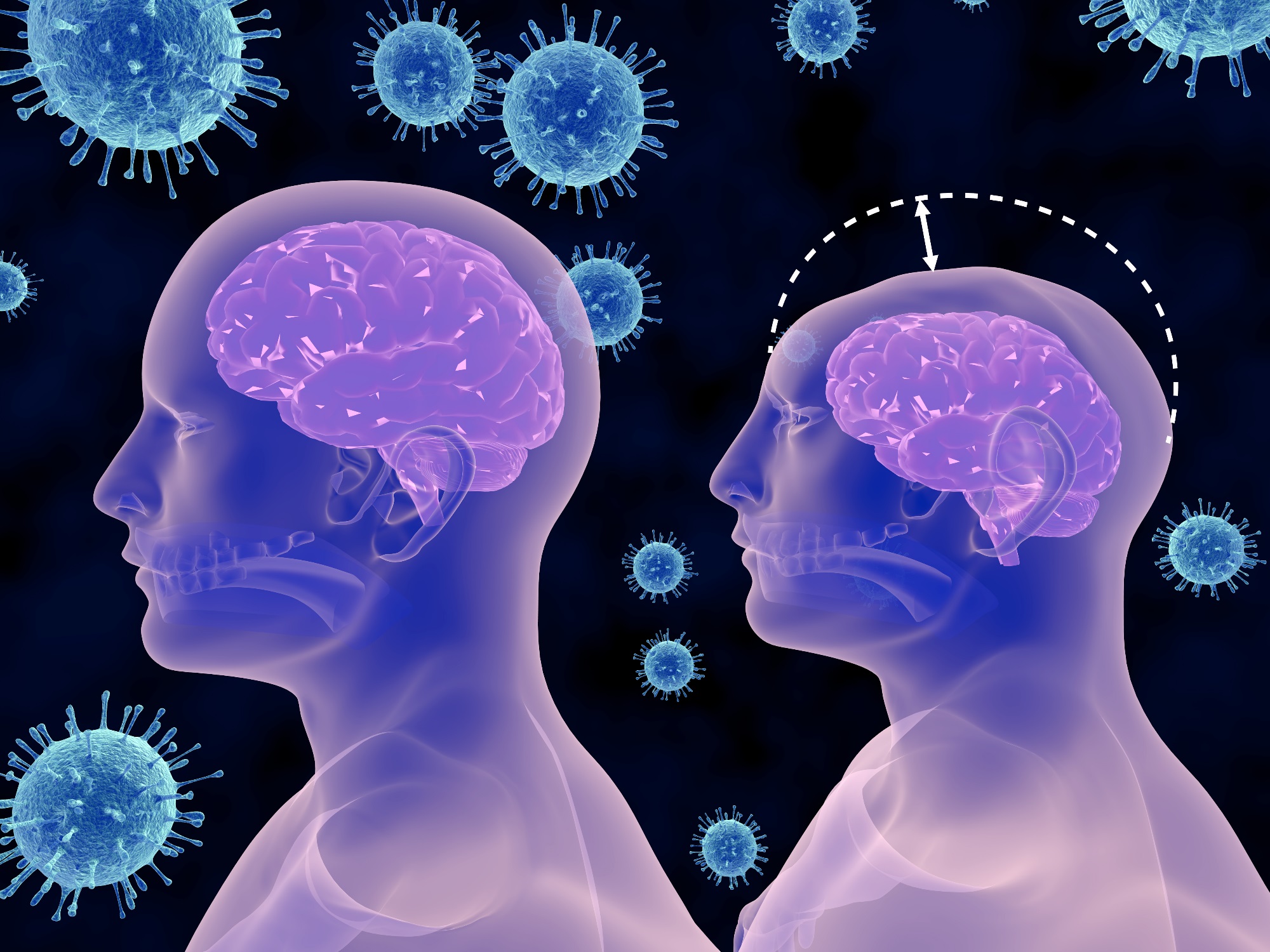 zika virus and microcephaly