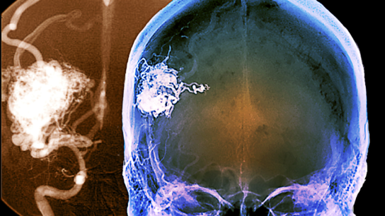arteriovenous malformation brain